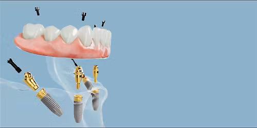 The Ultimate Full-Arch Digital Workflow with Photogrammetry