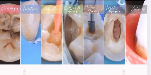 Bioteam Bordeaux 2026 - Dr Hugues De Belenet - La dent post\u00e9rieure et Masterclass Vertiprep