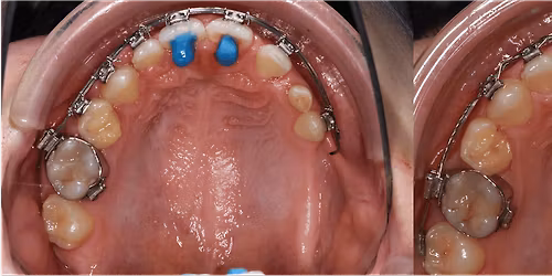 Charit\u00e9 Update - Autotransplantation