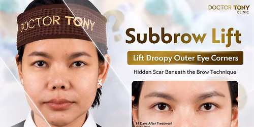 Tony Scar