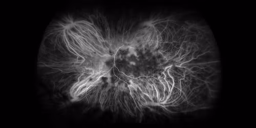 2025 Retina Update for the Optometrist