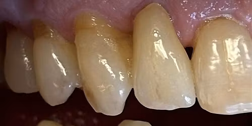 MiYo-Superior Esthetics for Monolithic Crowns