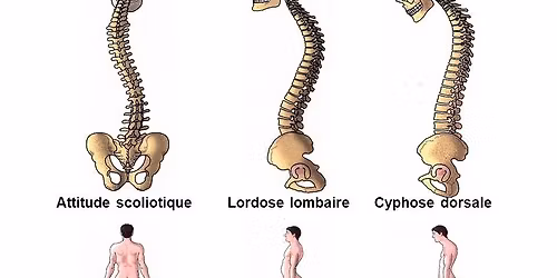 Atelier le sens des maladies ost\u00e9o-musculaires \u00e0 Oberbronn