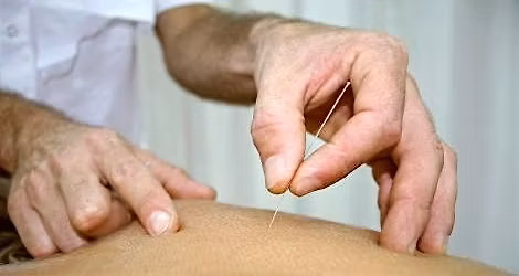Introduction to Dry Needling - CPD
