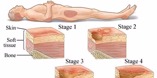 PGH Tissue Viability session