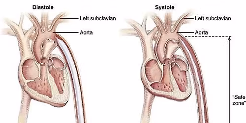 Intra Aortic Balloon Pump Training