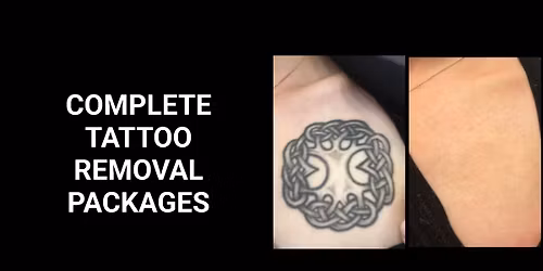 COMPLETE TATTOO REMOVAL PACKAGES!