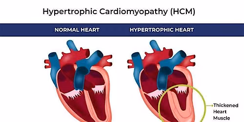 HCM: Diagnosis, Prevalence, Clinical Burden &  Management