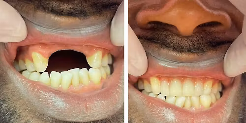 pr\u00f3tese m\u00f3vel 