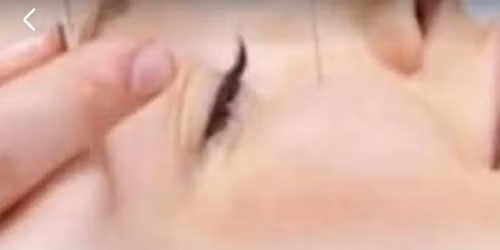 FORMATION INTENSIVE LIFTING PAR ACUPUNCTURE