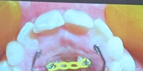 Tracci\u00f3n de caninos incluidos 