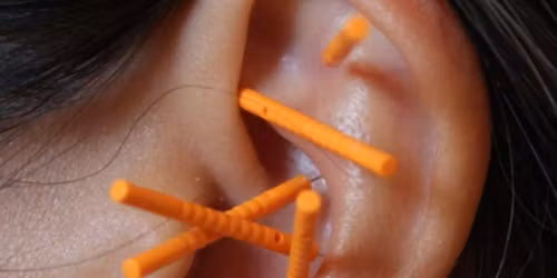 Group Aricular Acupuncture