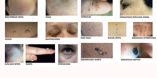 BIAE Advanced Blemish Removal - Models